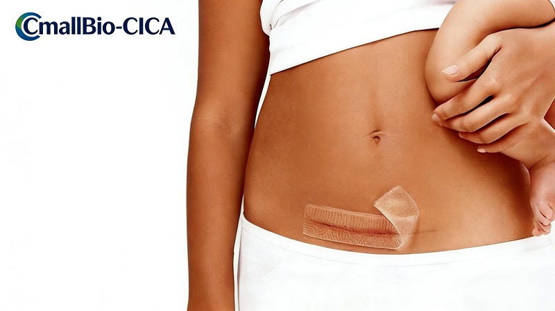 Ang CmallBio Thickened Silicone Scar Patch (CmallBio-CICA) ay mahusay na gumaganap Kamakailan, Pinapatatag ang Posisyon nito sa Nangungunang Tier ng Medical Silicone Scar Removal Field