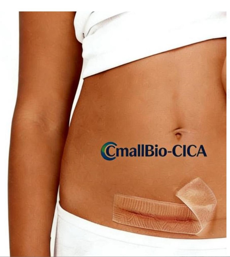 Anong Scar Patch ang Pinakamahusay para sa C-Section Hypertrophic Scars? Isang Gabay sa Pagbili ng Scar Patch sa 2026 na Markahang Medikal