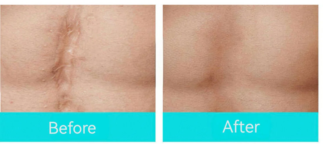 Elastic Waterproof Skin Colored Scar Patches